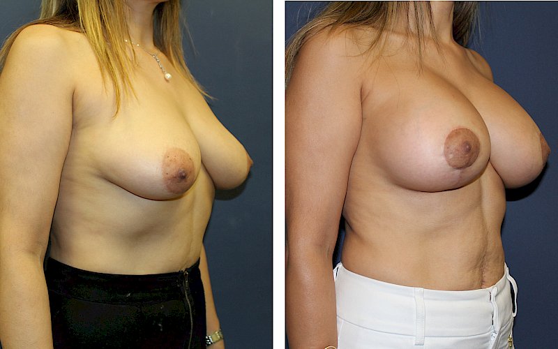 Breast Augmentation + Mastopexy Case Study at [[company]] - Before and After Photos