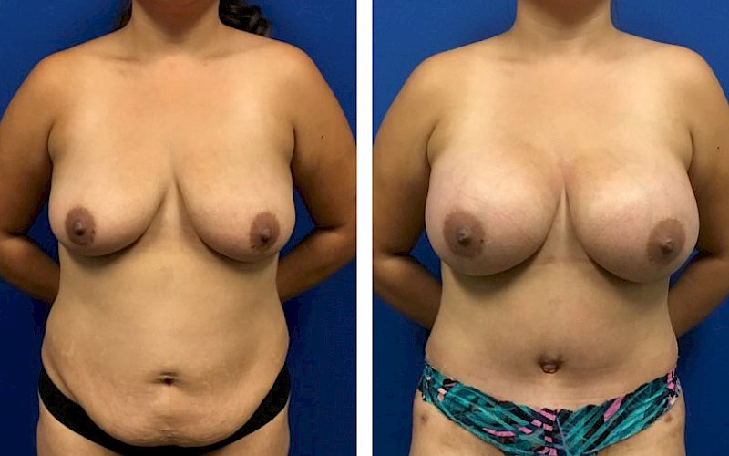 Breast Augmentation at [[company]] - Before and After Photo