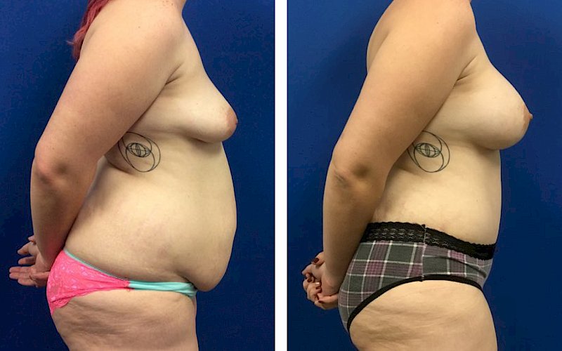 Breast Augmentation, Tummy Tuck, Liposuction Case Study at [[company]] - Before and After Photo