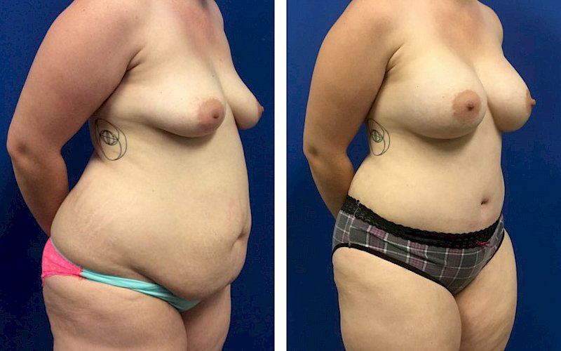 Breast Augmentation, Tummy Tuck, Liposuction Case Study at [[company]] - Before and After Photo