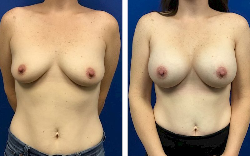 Breast Augmentation Case Study at [[company]] - Before and After Photos