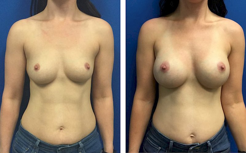 Breast Augmentation Case Study at [[company]] - Before and After Photos